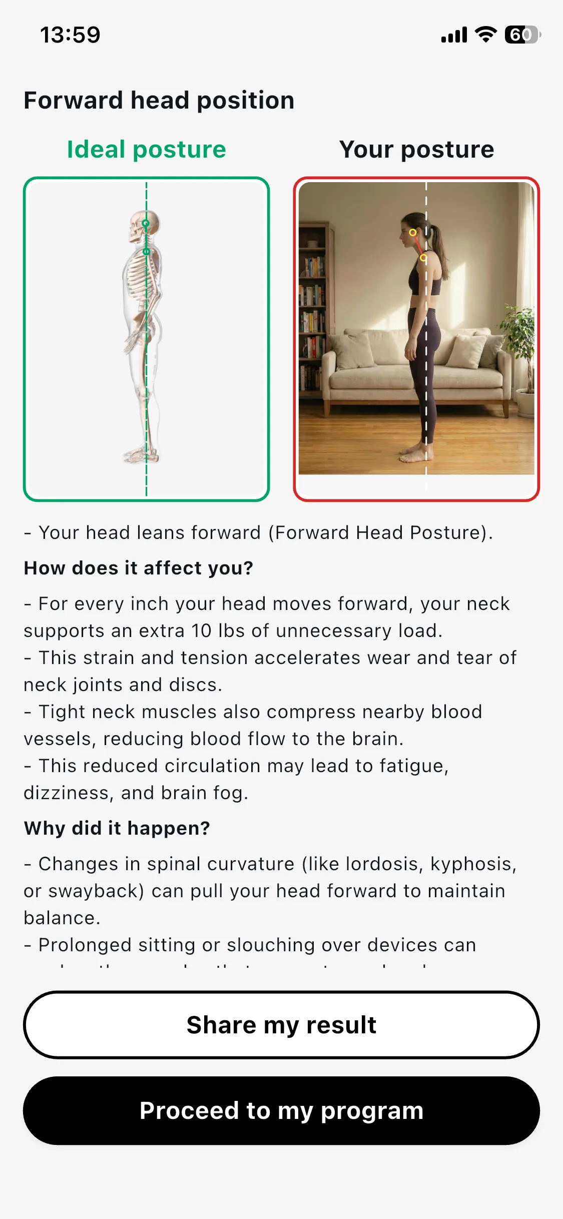 Assessment result — forward head position detected, ideal-posture vs your-posture comparison.
